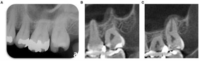 Partial Pulpotomy to Successfully Treat a Caries-Induced Pulpal Micro-Abscess: A Case Report